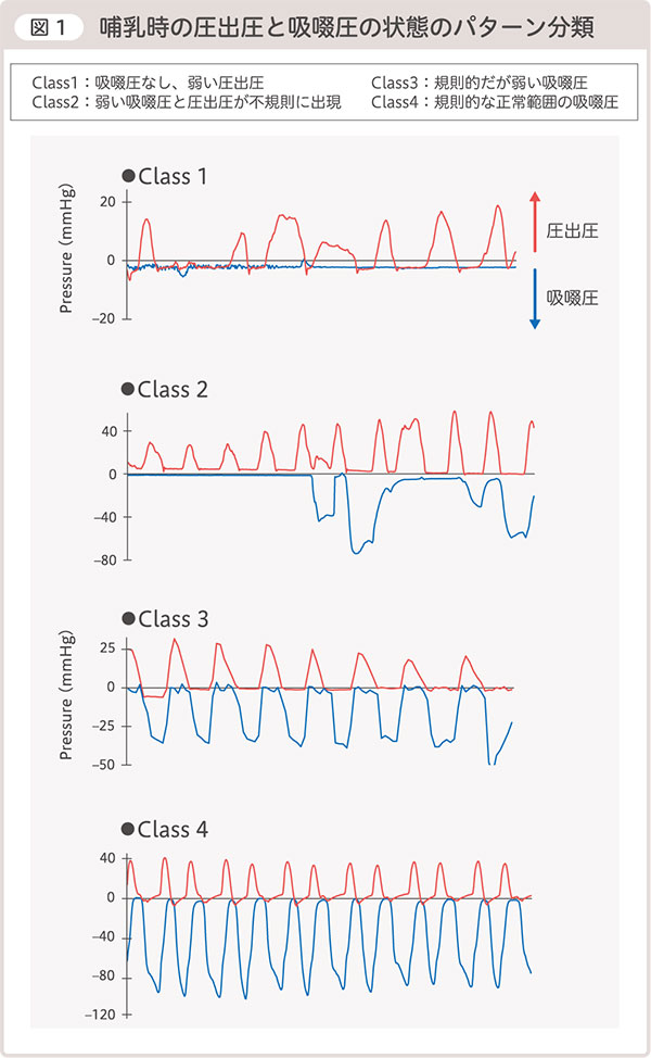 図１ 哺乳時の圧出圧と吸啜圧の状態のパターン分類
